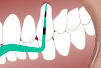 Dental Tourism - 61976 types