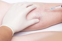разширени вени лечение - 3671 постижения разширени вени лечение - 34177 постижения
