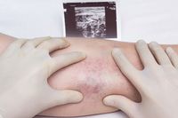разширени вени лечение - 4823 цени разширени вени лечение - 50544 цени