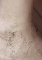 тромбофлебит - 86593 оферти