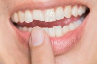 Invisalign - 66910 варианти