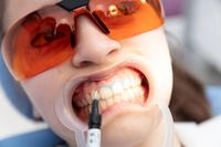 избелване на зъби - 25902 награди избелване на зъби - 79489 награди