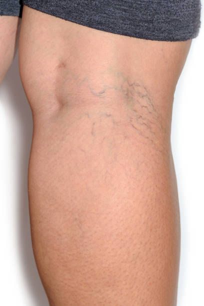 склеротерапия - 21601 отстъпки | spectroima.com склеротерапия - 99674 отстъпки